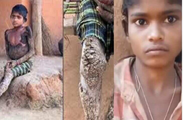 वीडियो में देंखे राजस्थान में 9 साल के बच्चे में सामने आई दुर्लभ &ldquo;स्टोन मैन सिंड्रोम&rdquo;