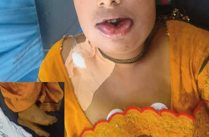 इंदौर में फूड सेफ्टी पर चिंता, हल्दी में खतरनाक रसायन मिलने का शक; चार मरीज अस्पताल में भर्ती