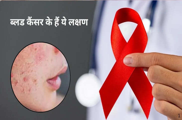 Blood Cancer Warning Signs: त्वचा पर दिख रहे लगातार दाने-चकत्ते को न करें नजरअंदाज, हो सकता है गंभीर रोग