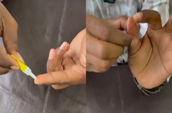 फेवीक्विक से चिपकी उंगली कैसे छुड़ाएं? वायरल वीडियो में बताया आसान तरीका