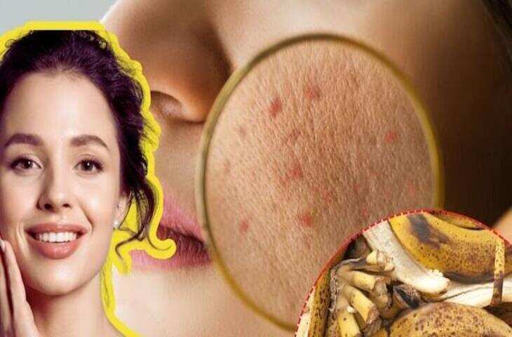 स्किन केयर टिप्स: पिंपल्स और ग्लोइंग स्किन के लिए केले का छिलका कितना असरदार है? जानिए इसके चौंकाने वाले फायदे