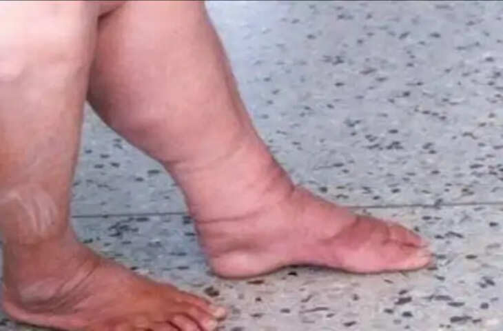 Chapra फाइलेरिया के लिए शुरू होगा नाइट ब्लड सर्वे